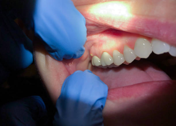Best Emergency Dental Extractions in Toledo, IL